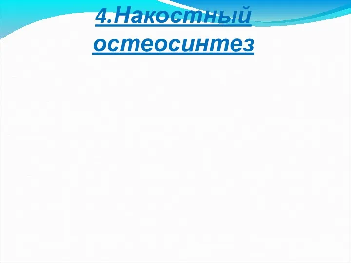 4.Накостный остеосинтез