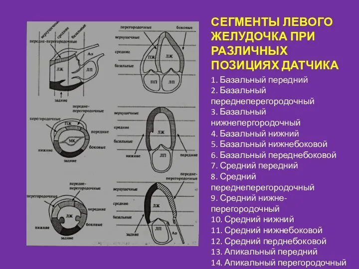 СЕГМЕНТЫ ЛЕВОГО ЖЕЛУДОЧКА ПРИ РАЗЛИЧНЫХ ПОЗИЦИЯХ ДАТЧИКА 1. Базальный передний 2. Базальный