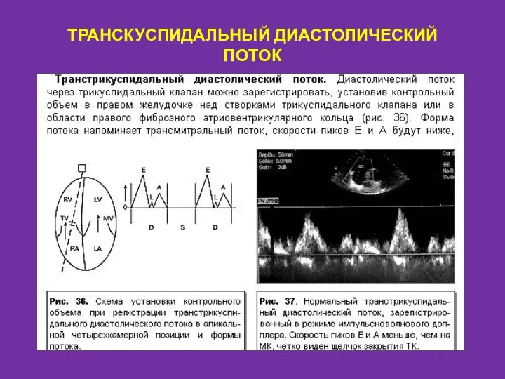 ТРАНСКУСПИДАЛЬНЫЙ ДИАСТОЛИЧЕСКИЙ ПОТОК