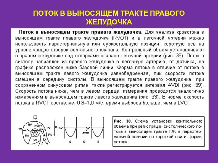 ПОТОК В ВЫНОСЯЩЕМ ТРАКТЕ ПРАВОГО ЖЕЛУДОЧКА