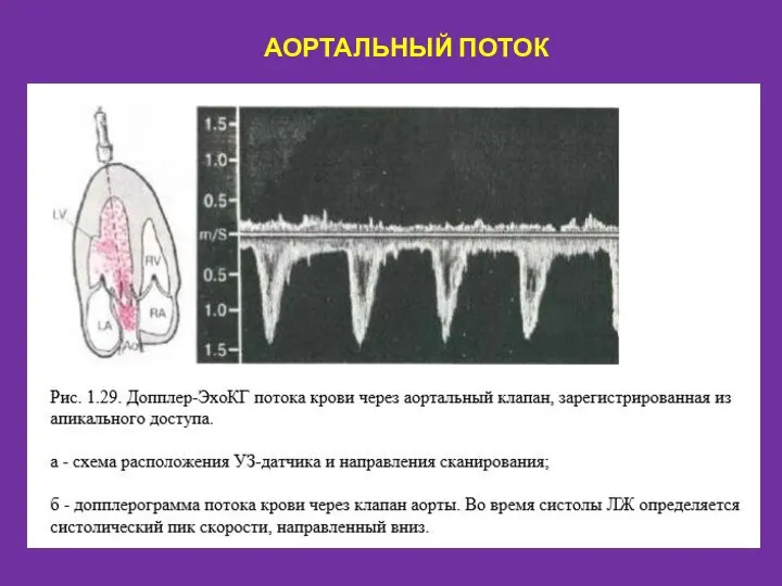 АОРТАЛЬНЫЙ ПОТОК