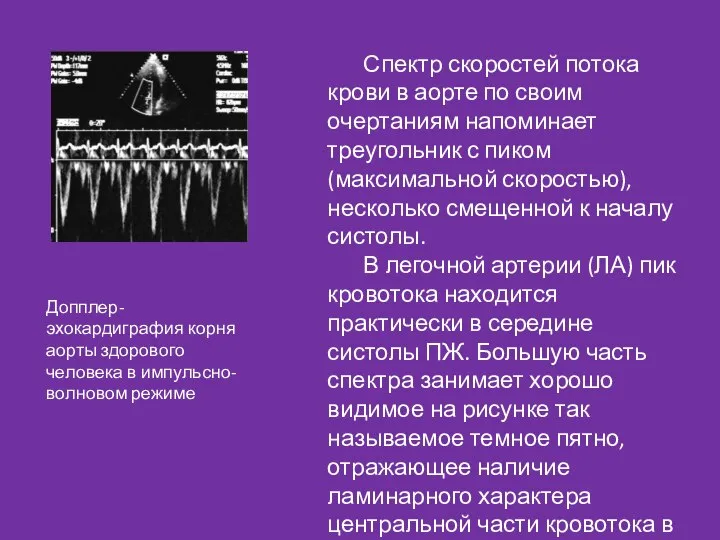 Спектр скоростей потока крови в аорте по своим очертаниям напоминает треугольник с