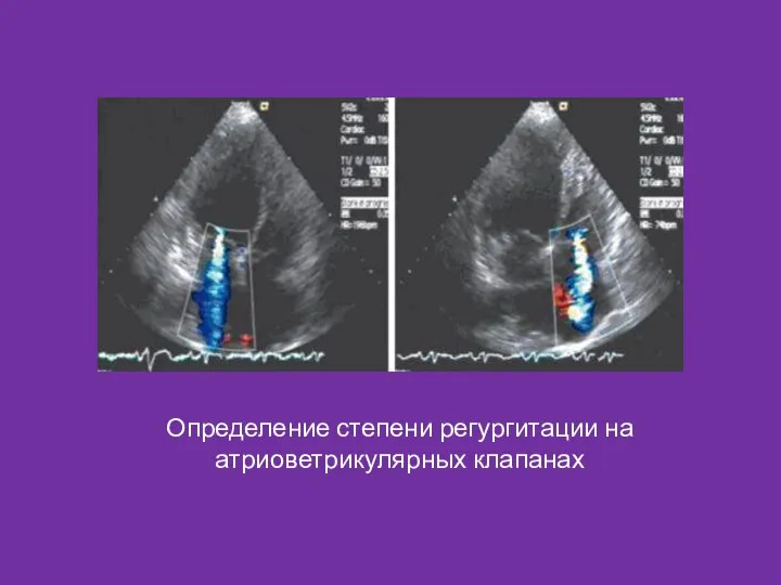 Определение степени регургитации на атриоветрикулярных клапанах