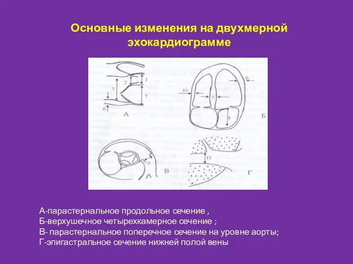 Основные изменения на двухмерной эхокардиограмме А-парастернальное продольное сечение , Б-верхушечное четырехкамерное сечение