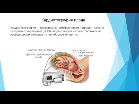 Кардиотография плода Кардиотокография — непрерывная синхронная регистрация частоты сердечных сокращений (ЧСС) плода