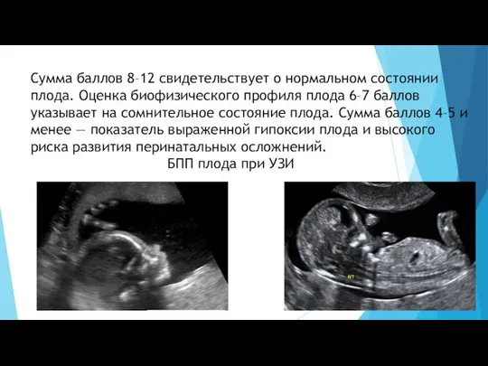 Сумма баллов 8–12 свидетельствует о нормальном состоянии плода. Оценка биофизического профиля плода