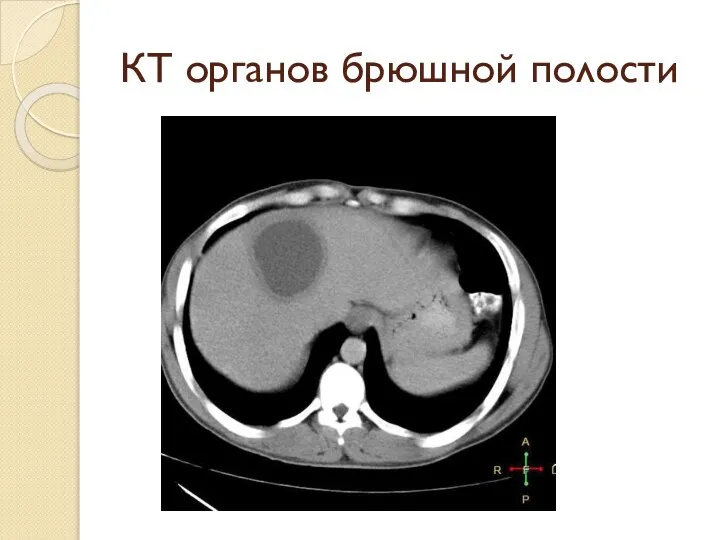 КТ органов брюшной полости