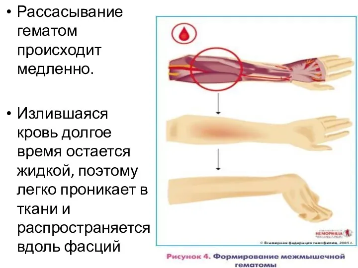 Рассасывание гематом происходит медленно. Излившаяся кровь долгое время остается жидкой, поэтому легко