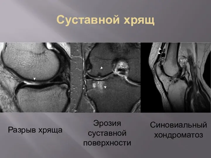 Суставной хрящ Разрыв хряща Эрозия суставной поверхности Синовиальныйхондроматоз