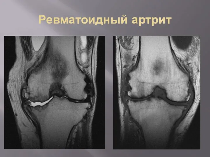 Ревматоидный артрит