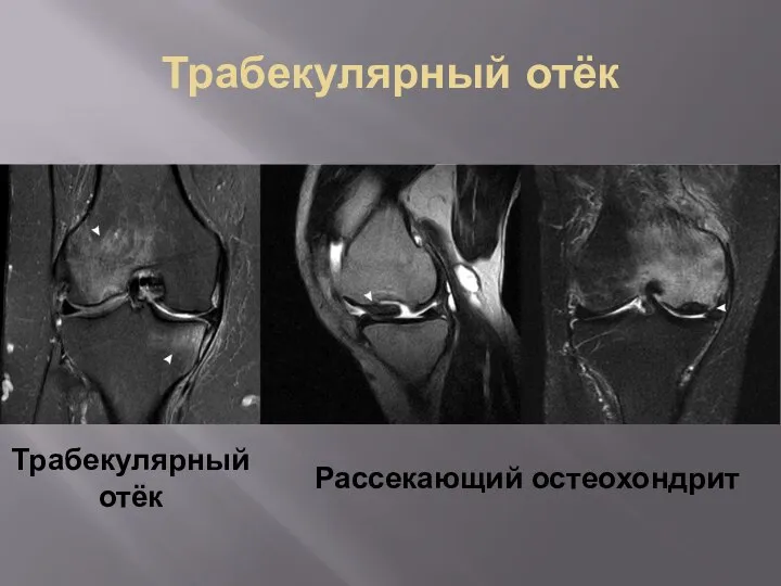 Трабекулярный отёк Трабекулярный отёк Рассекающий остеохондрит