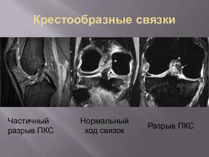 Крестообразные связки Частичный разрыв ПКС Нормальный ход связок Разрыв ПКС