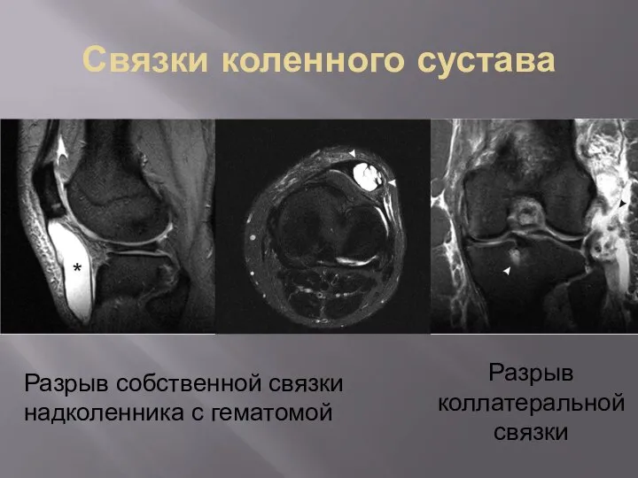 Связки коленного сустава Разрыв собственной связки надколенника с гематомой Разрыв коллатеральной связки