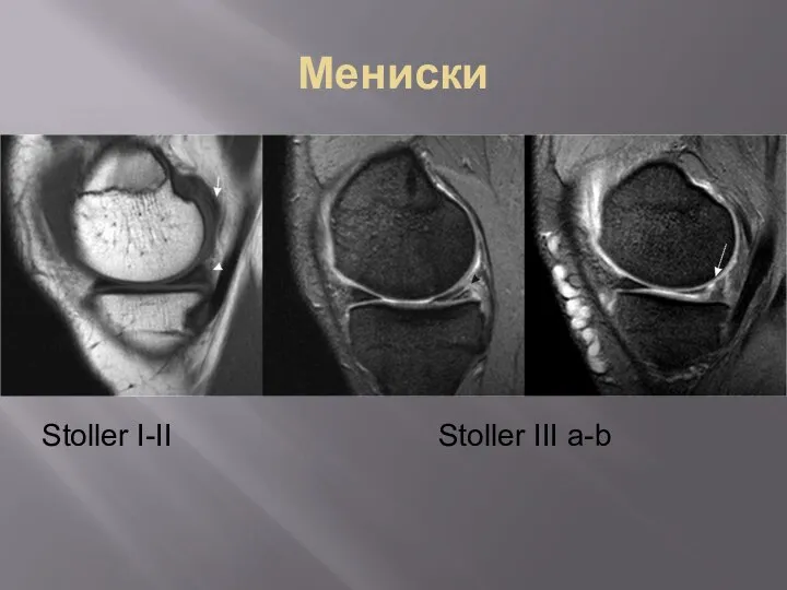 Мениски Stoller I-II Stoller III a-b