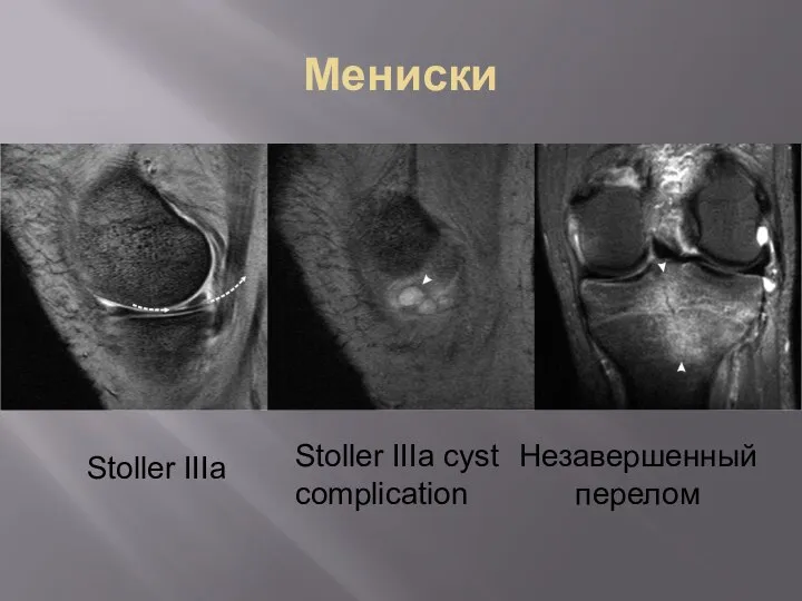 Мениски Stoller IIIa Stoller IIIa cyst complication Незавершенный перелом