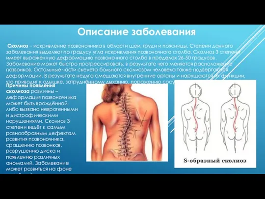 Описание заболевания Сколиоз – искривление позвоночника в области шеи, груди и поясницы.