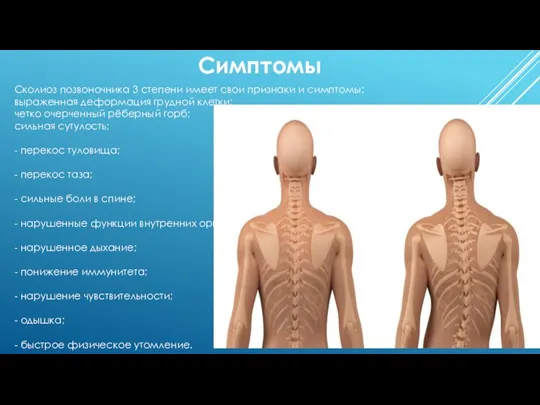 Симптомы Сколиоз позвоночника 3 степени имеет свои признаки и симптомы: выраженная деформация