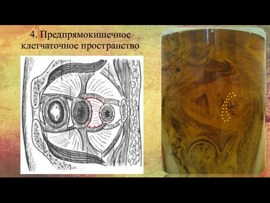 4. Предпрямокишечное клетчаточное пространство