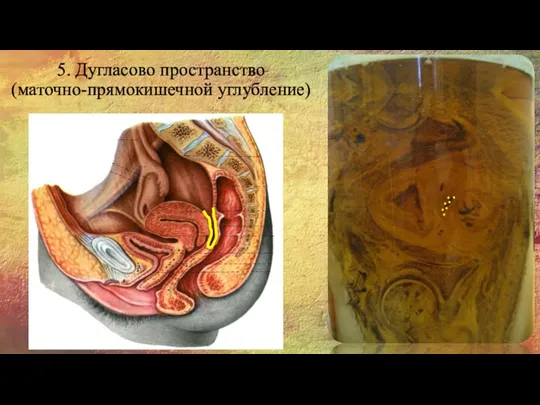 5. Дугласово пространство (маточно-прямокишечной углубление)