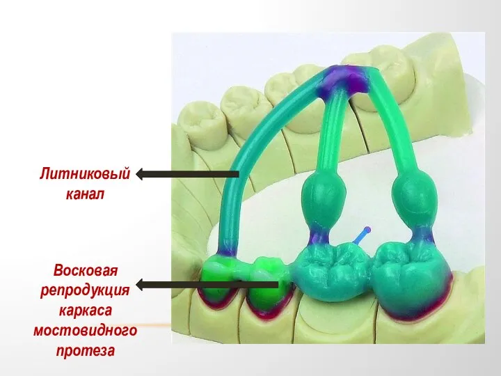 Восковая репродукция каркаса мостовидного протеза Литниковый канал