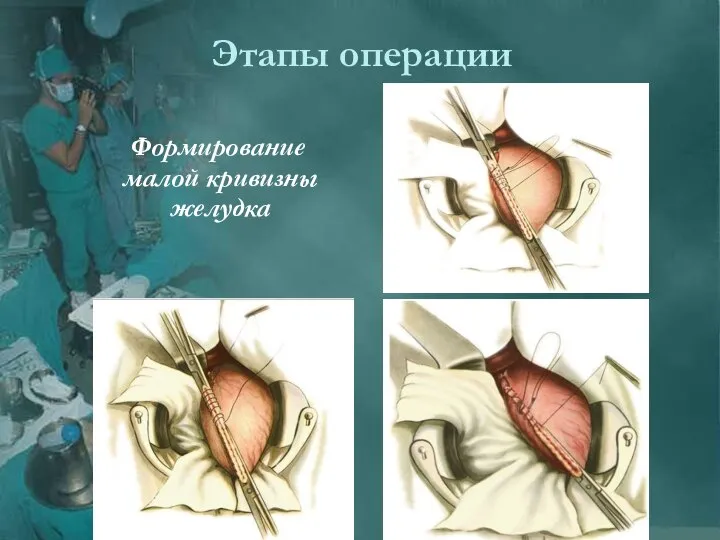 Этапы операции Формирование малой кривизны желудка