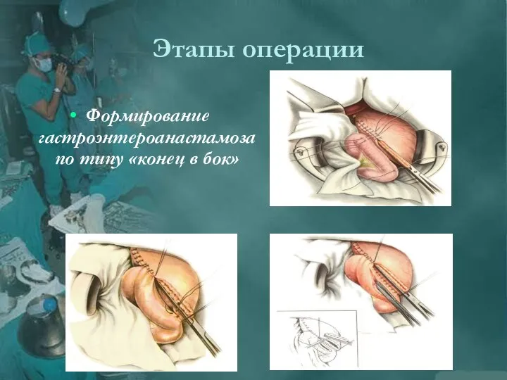 Этапы операции Формирование гастроэнтероанастамоза по типу «конец в бок»