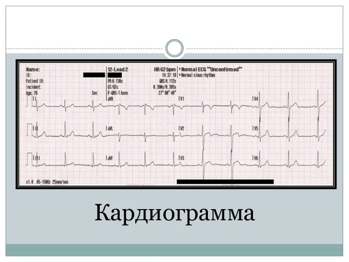 Кардиограмма