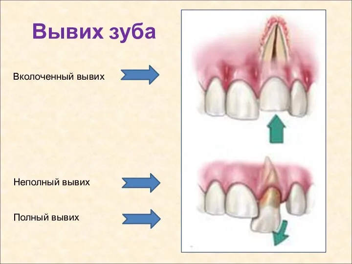 Вывих зуба Вколоченный вывих Неполный вывих Полный вывих