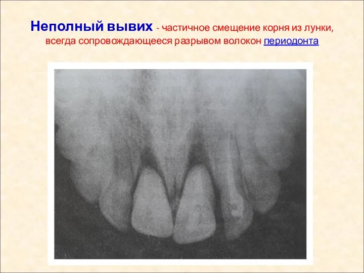 Неполный вывих - частичное смещение корня из лунки, всегда сопровождающееся разрывом волокон периодонта