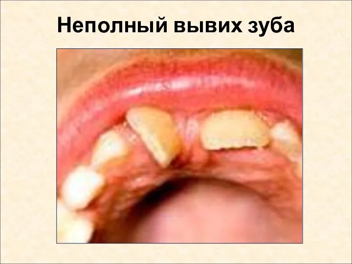 Неполный вывих зуба