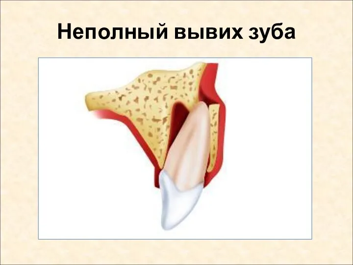 Неполный вывих зуба