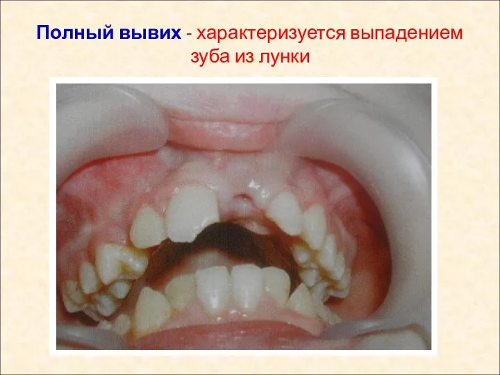 Полный вывих - характеризуется выпадением зуба из лунки