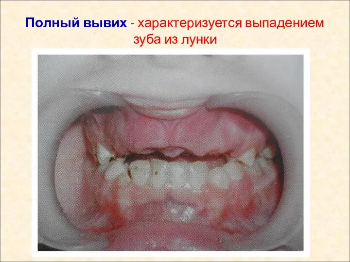 Полный вывих - характеризуется выпадением зуба из лунки