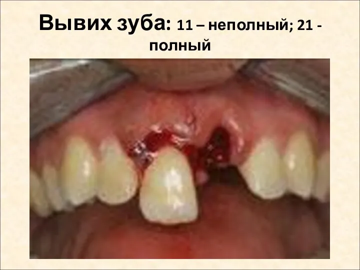 Вывих зуба: 11 – неполный; 21 - полный