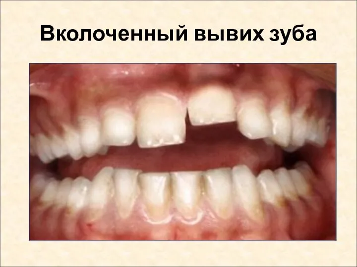 Вколоченный вывих зуба