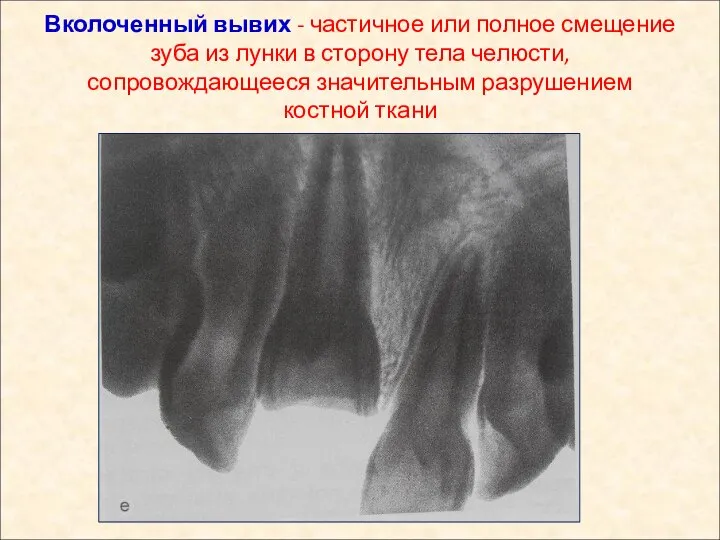 Вколоченный вывих - частичное или полное смещение зуба из лунки в сторону