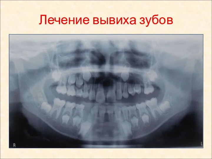 Лечение вывиха зубов