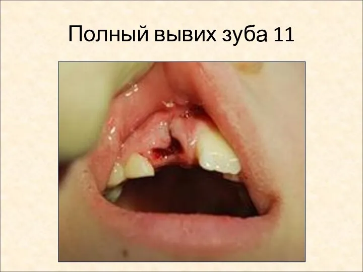 Полный вывих зуба 11