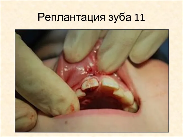 Реплантация зуба 11
