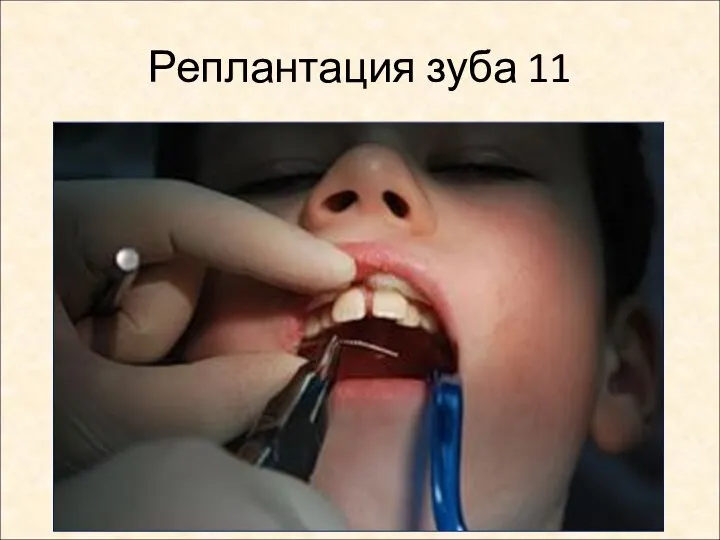 Реплантация зуба 11