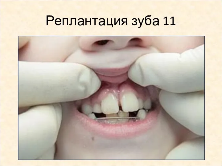 Реплантация зуба 11