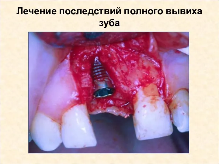 Лечение последствий полного вывиха зуба