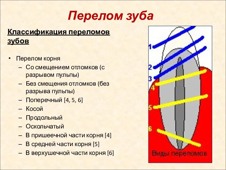 Перелом зуба Классификация переломов зубов Перелом корня Со смещением отломков (с разрывом