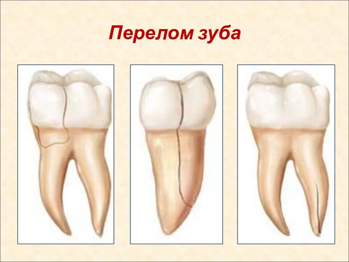 Перелом зуба