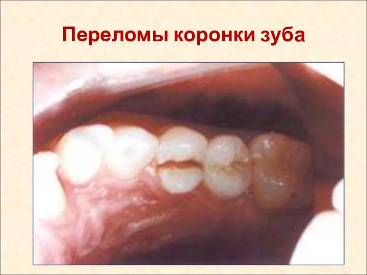 Переломы коронки зуба