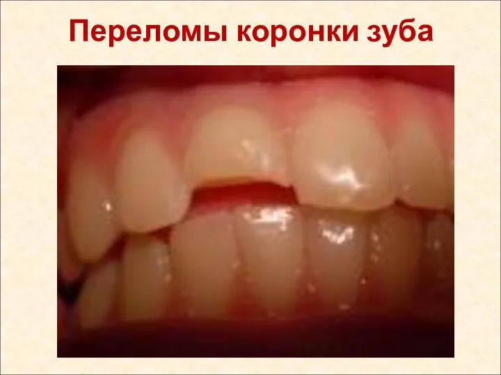 Переломы коронки зуба