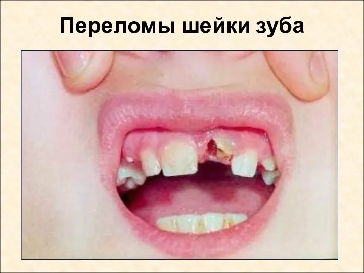 Переломы шейки зуба