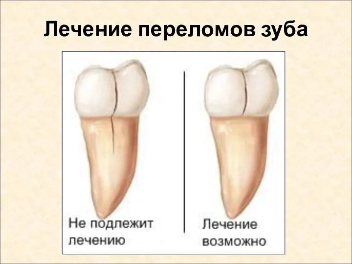 Лечение переломов зуба