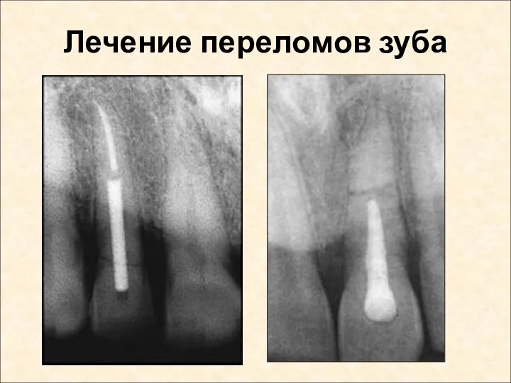 Лечение переломов зуба