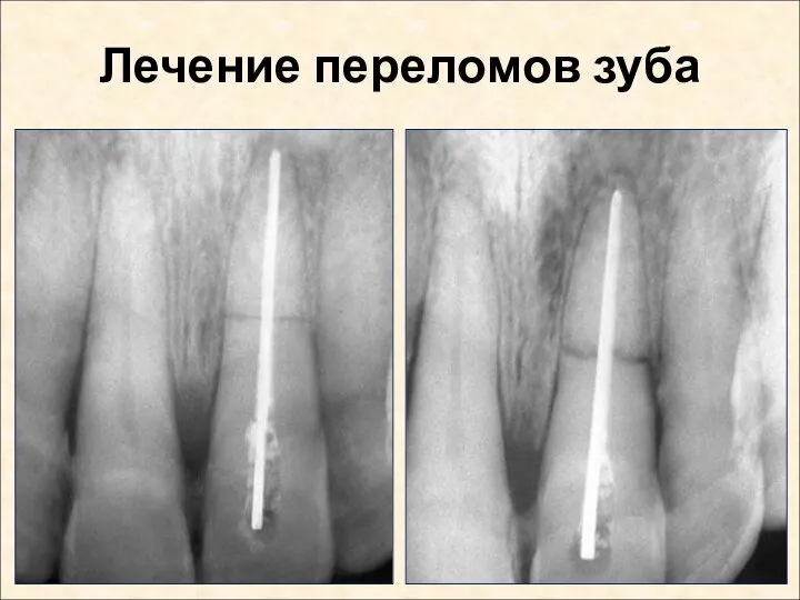 Лечение переломов зуба